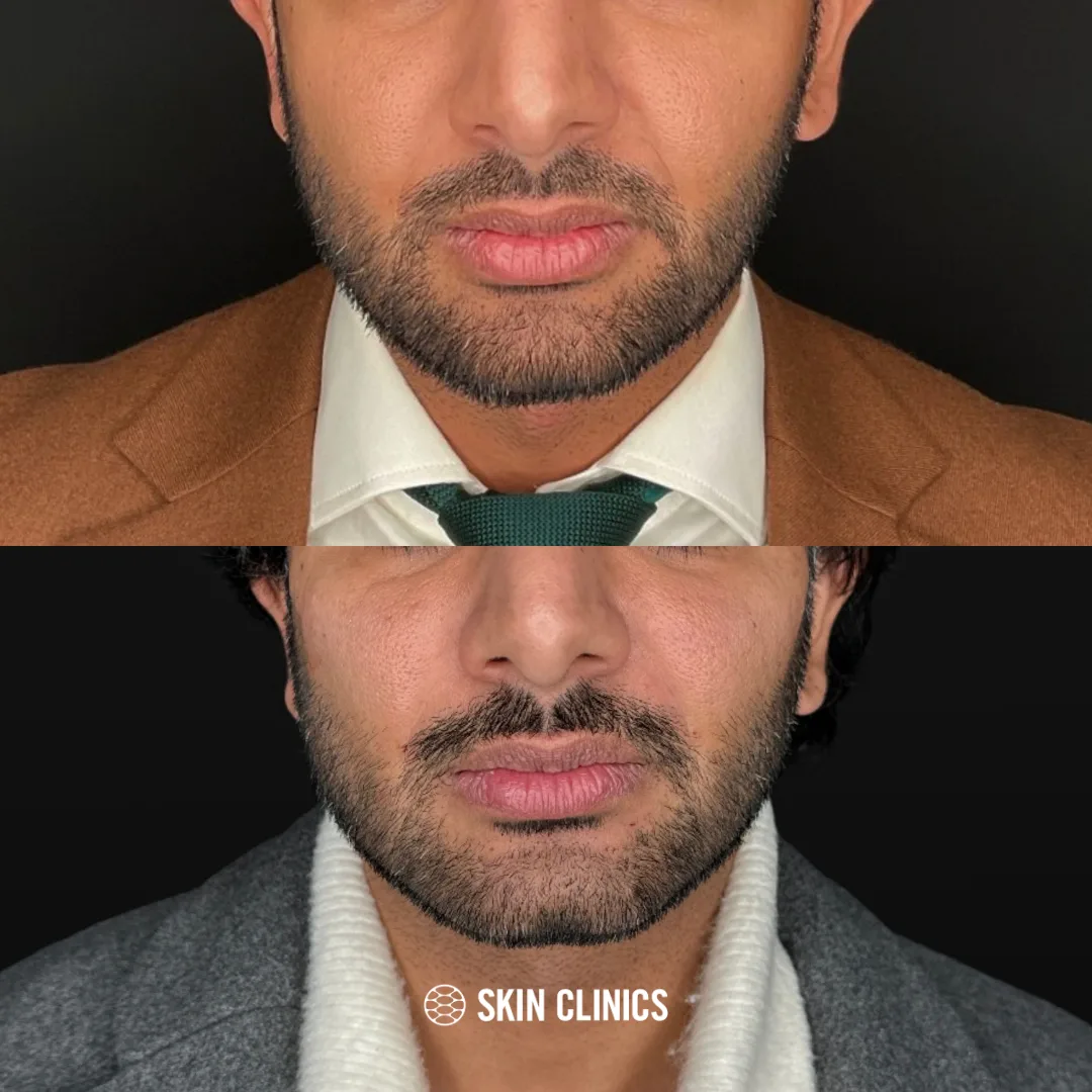 Dermal filler in the jaw, chin and cheeks for more masculine features