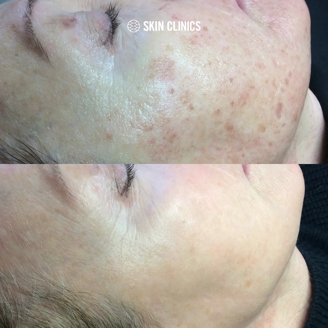 IPL targeting redness in the face