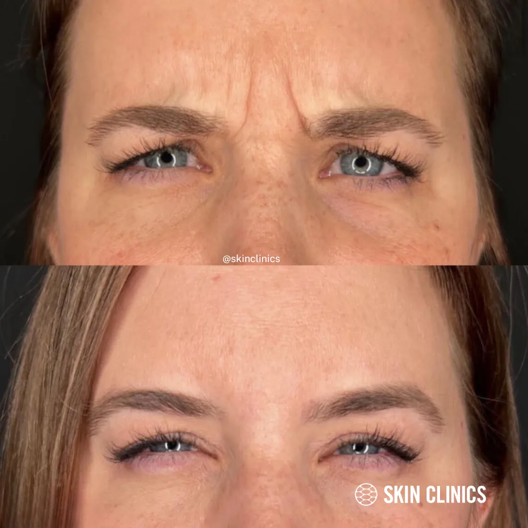 Neuromodulator Treatment: Elevens