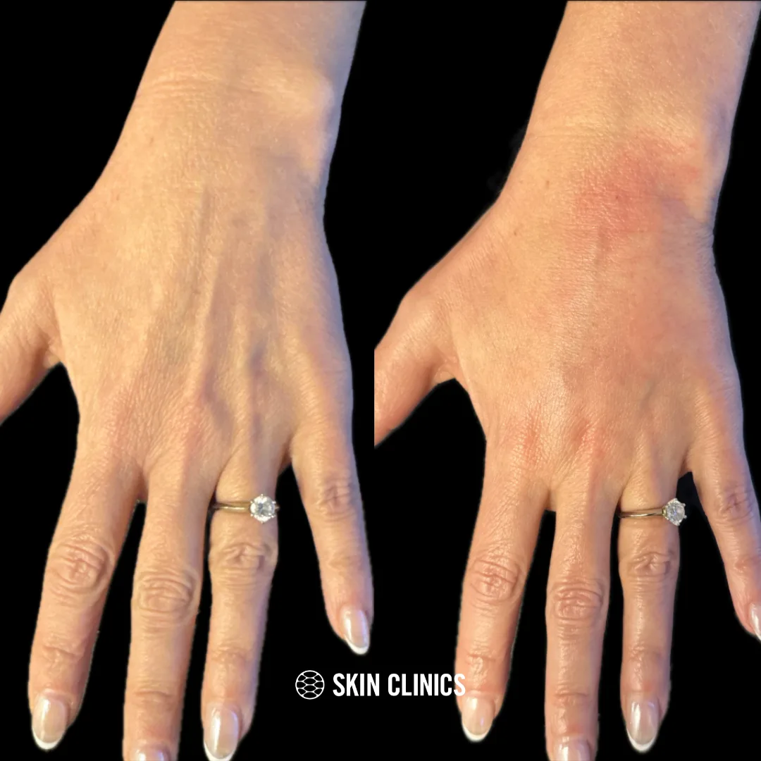 Radiesse in the hands