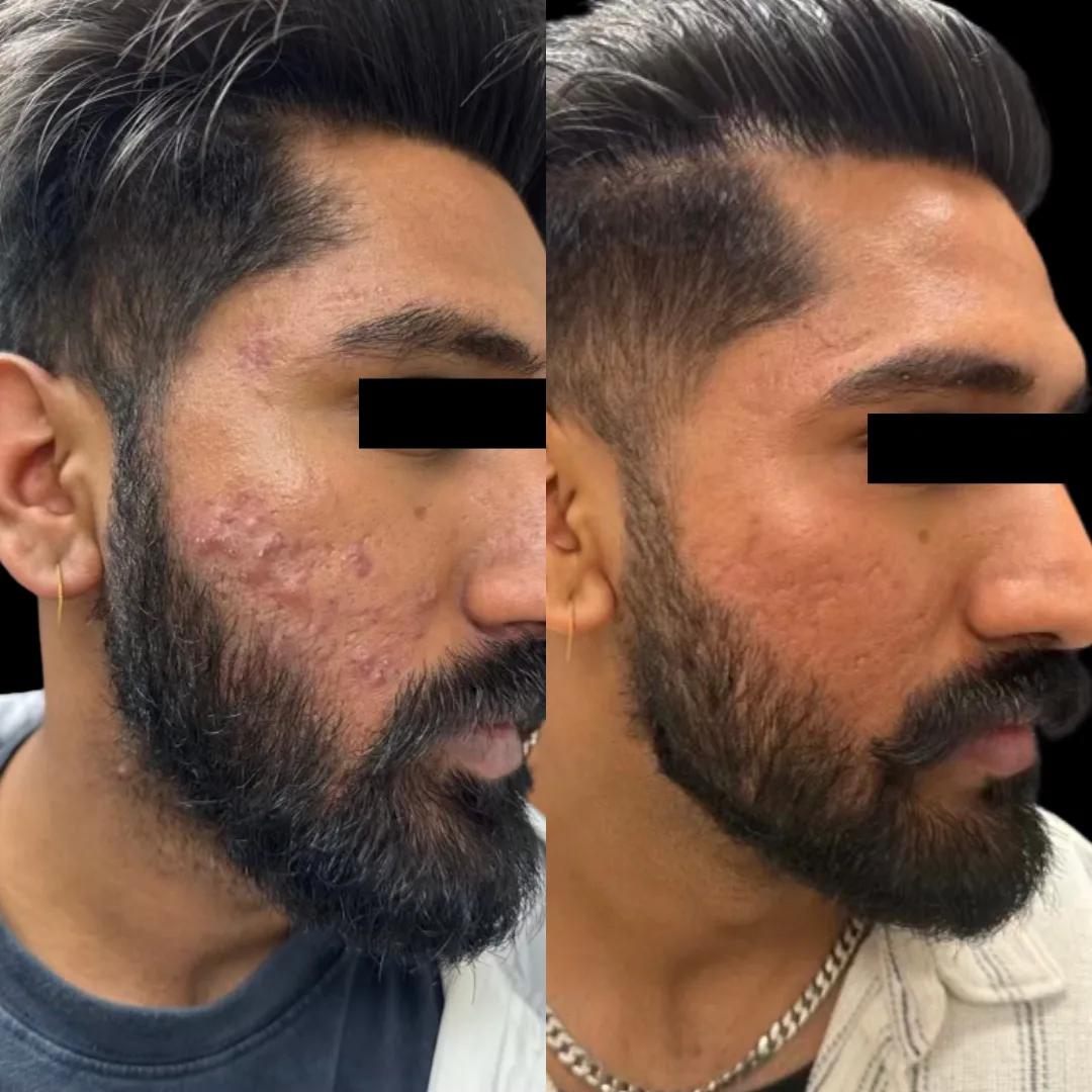 Microneedling and Chemical Peel Treatment Plan